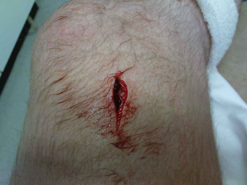 knee_wound.jpg