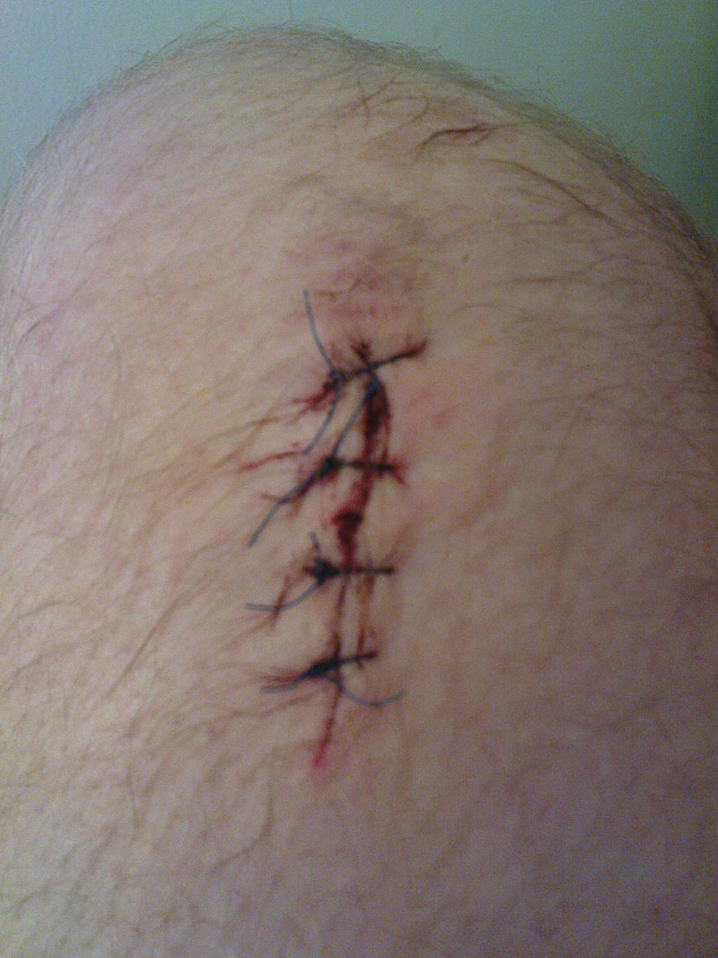 knee_wound_stitched.jpg